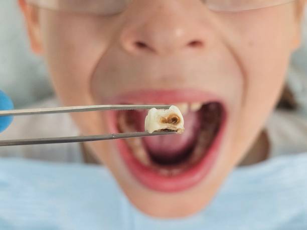 Best Emergency Root Canal Treatment in Houghton Lake, MI